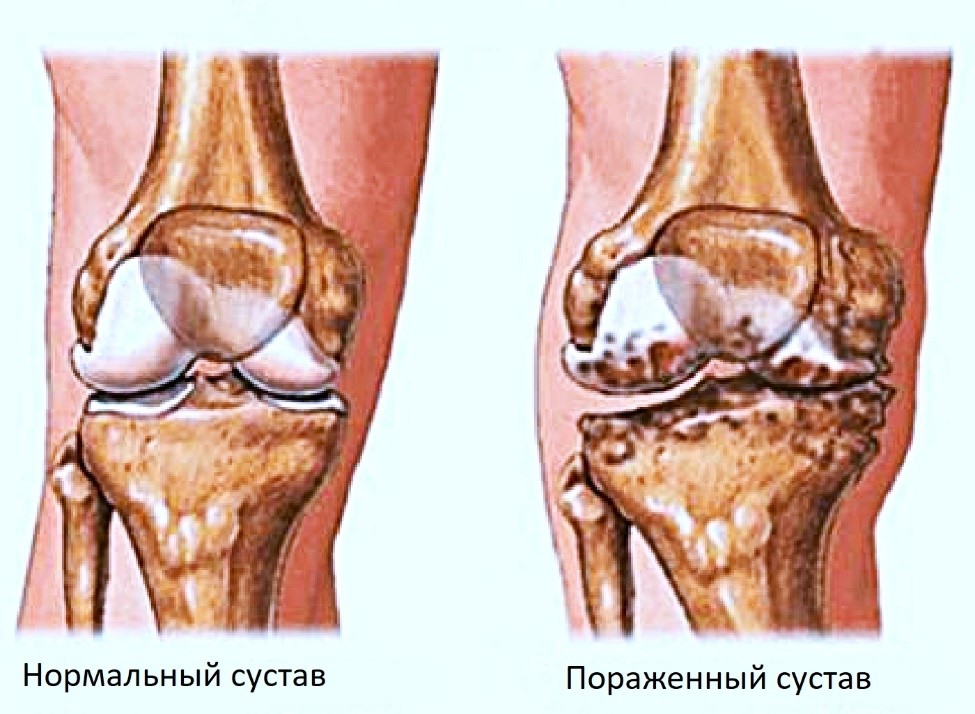гонартроз Гонартроз - заболевание