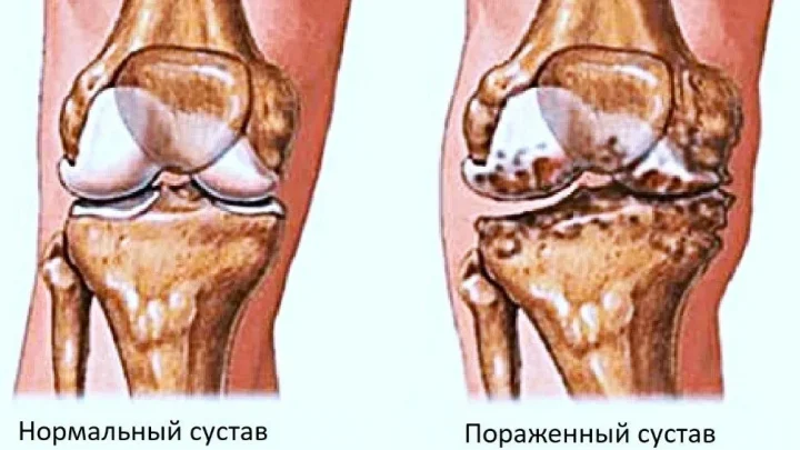 гонартроз
